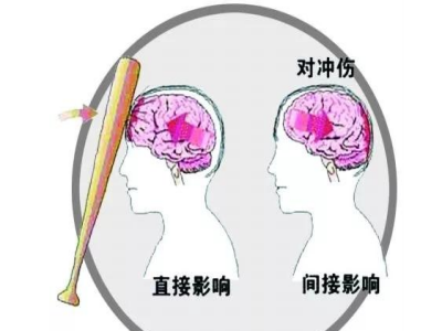 脑外伤