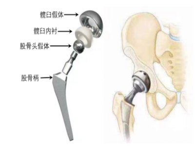 髋关节置换