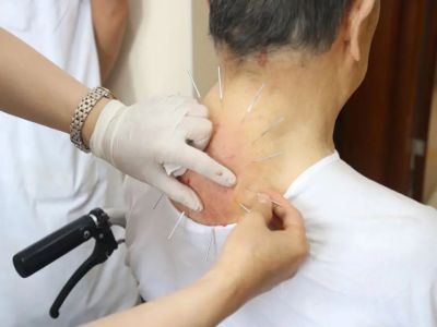 金诚针灸1
