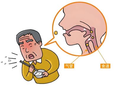 吞咽障碍2