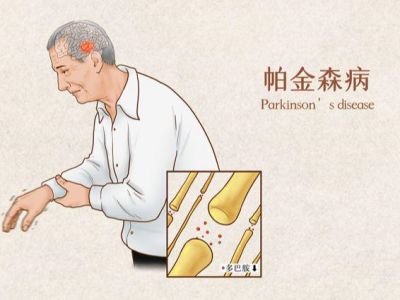 帕金森