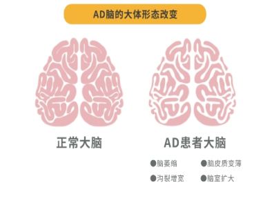 阿尔兹海默症