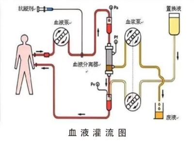 血液灌流.jpeg