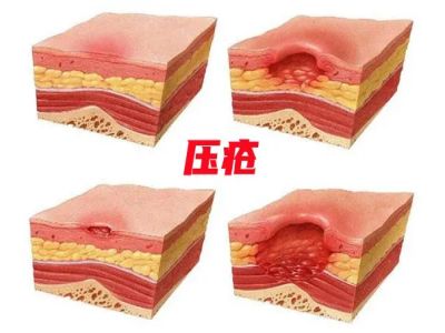 压疮