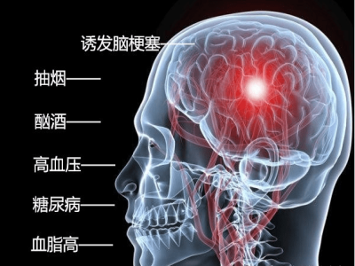 脑梗塞诱因.png