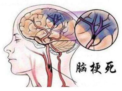 脑梗