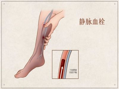 下肢深静脉血栓