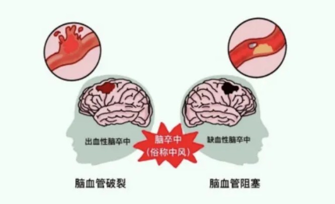 脑卒中1