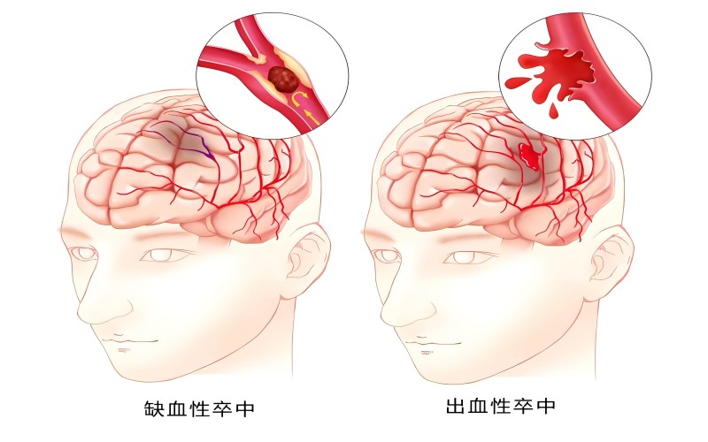 脑卒中