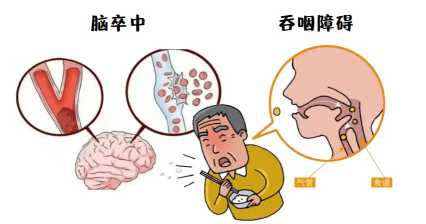 吞咽障碍1