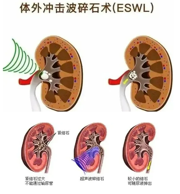 碎石