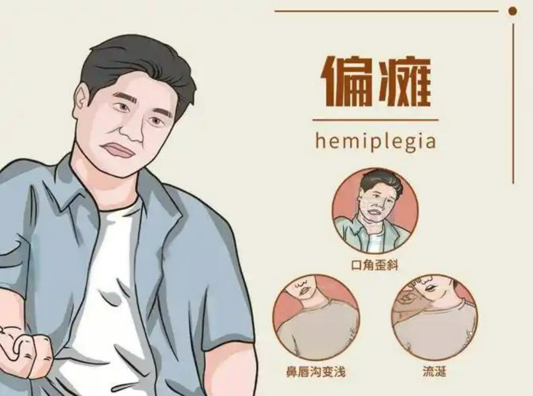 偏瘫