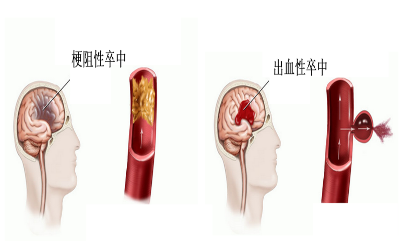 脑卒中