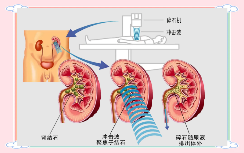 碎石