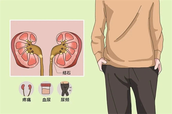 【24小时碎石】杭州临平广和医院开通夜间碎石 (3).jpg