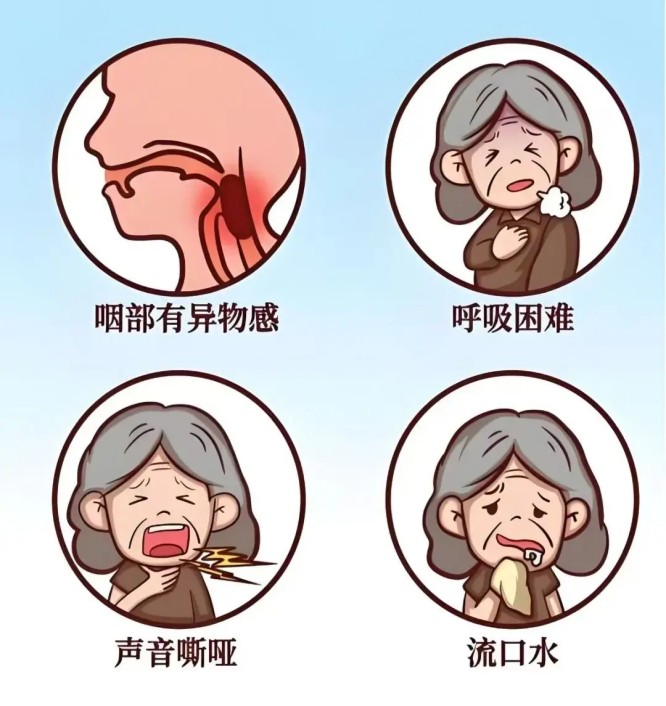 吞咽障碍