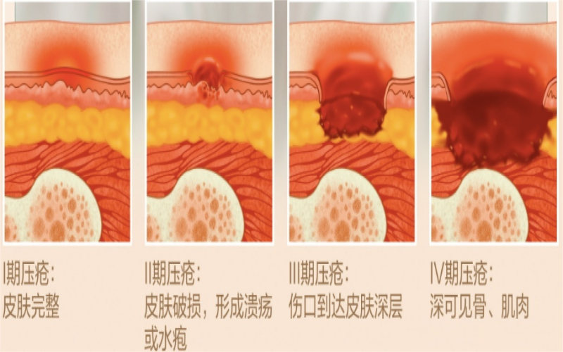压疮(2)