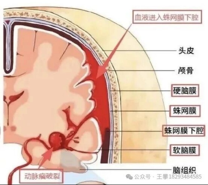 蛛网膜下腔出血